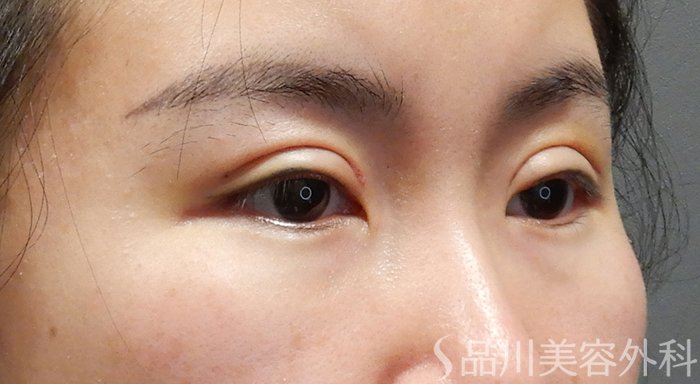 症例NO.69334のAFTER写真