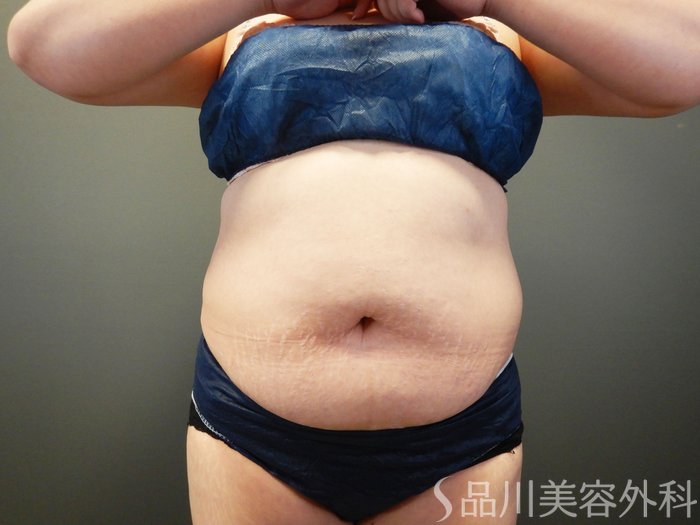 症例NO.64956のBEFORE写真