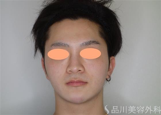 症例NO.51907のBEFORE写真