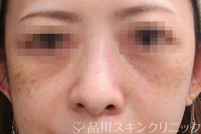 症例NO.75097のBEFORE写真