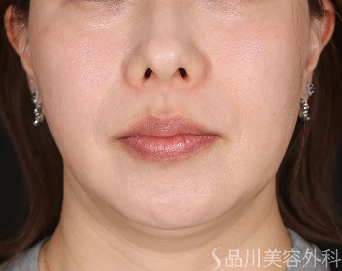 症例NO.73868のAFTER写真