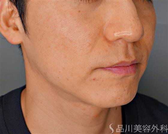 症例NO.53173のBEFORE写真