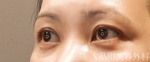 症例NO.72121のAFTER写真