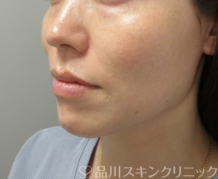 症例NO.73182のAFTER写真