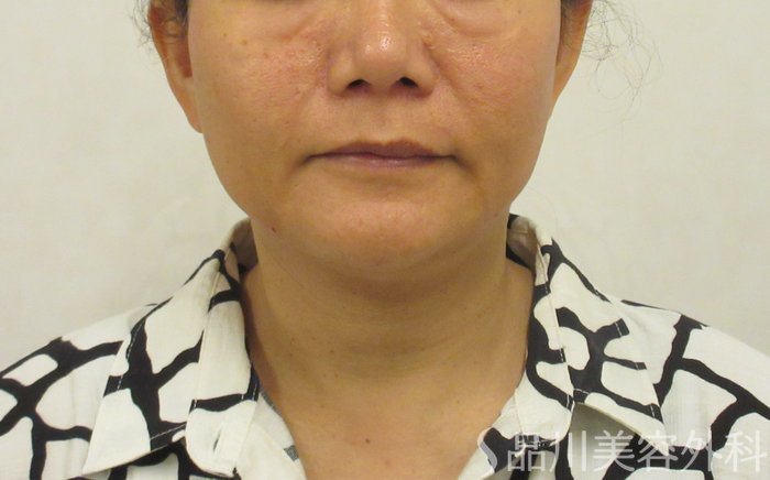 症例NO.72116のAFTER写真