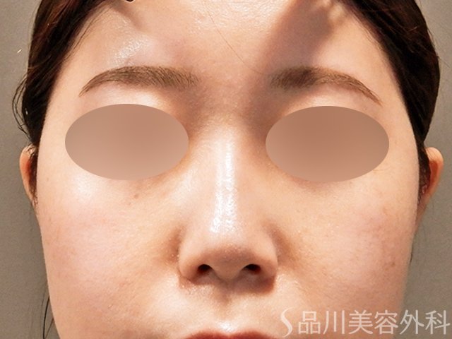 症例NO.69518のAFTER写真