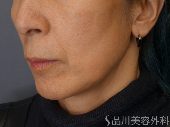 症例NO.67832のBEFORE写真