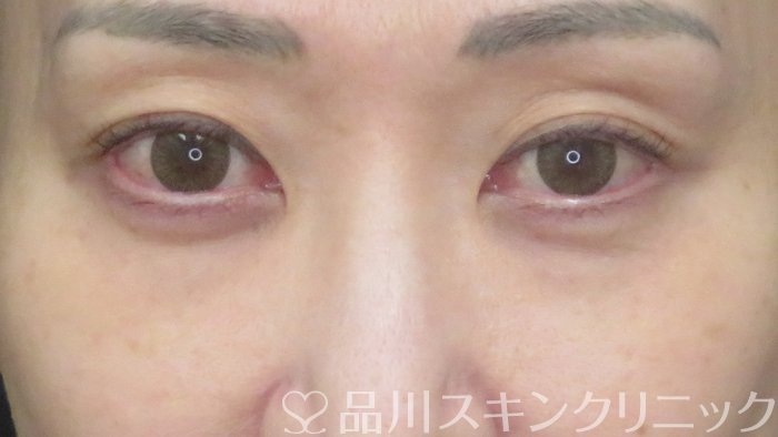 症例NO.72171のBEFORE写真