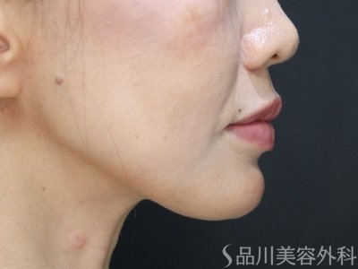 症例NO.75067のAFTER写真
