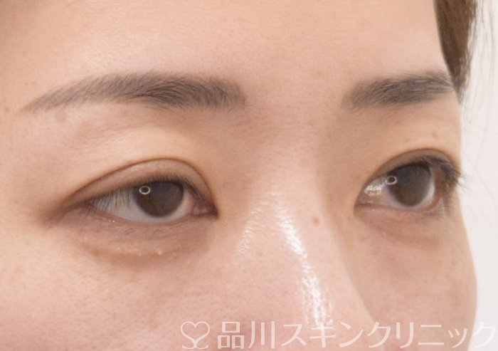 症例NO.70969のBEFORE写真