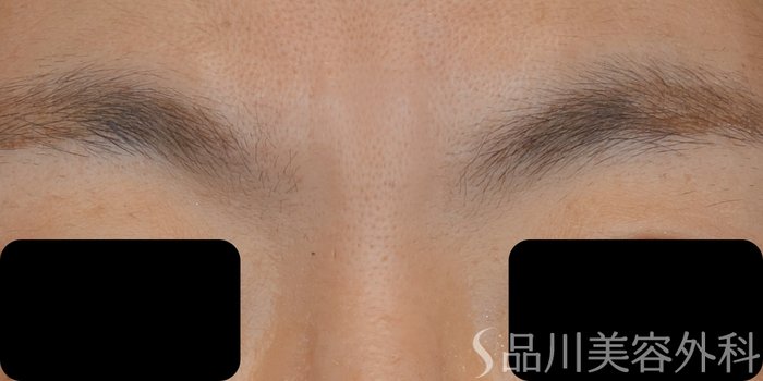 症例NO.72169のAFTER写真