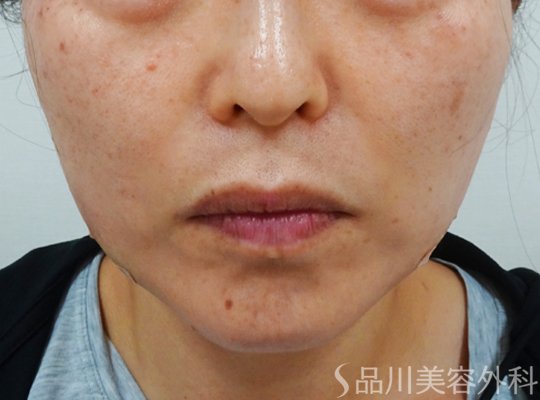 症例NO.73393のAFTER写真