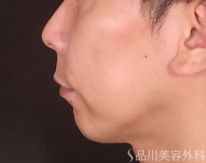 症例NO.70483のBEFORE写真