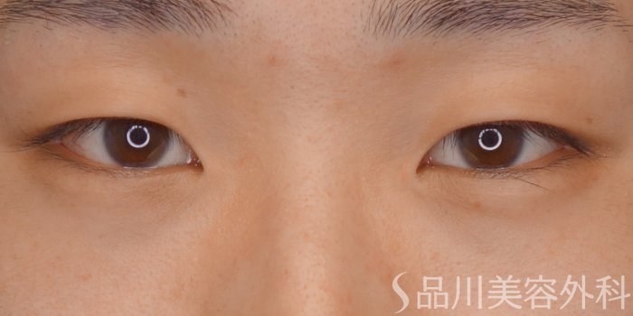 症例NO.66411のBEFORE写真