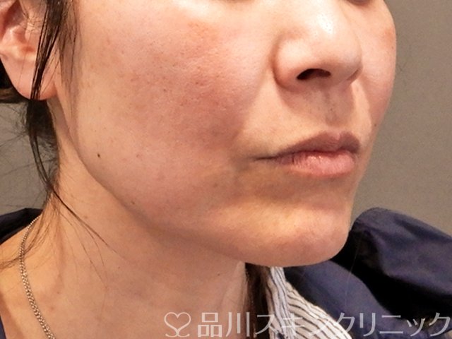 症例NO.70824のBEFORE写真