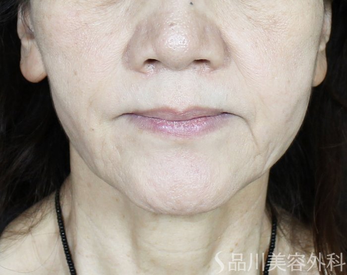 症例NO.62447のAFTER写真
