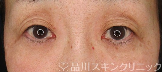 症例NO.64575のBEFORE写真