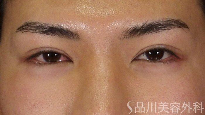 症例NO.70970のAFTER写真