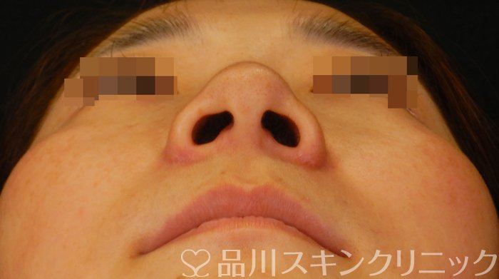 症例NO.66808のAFTER写真
