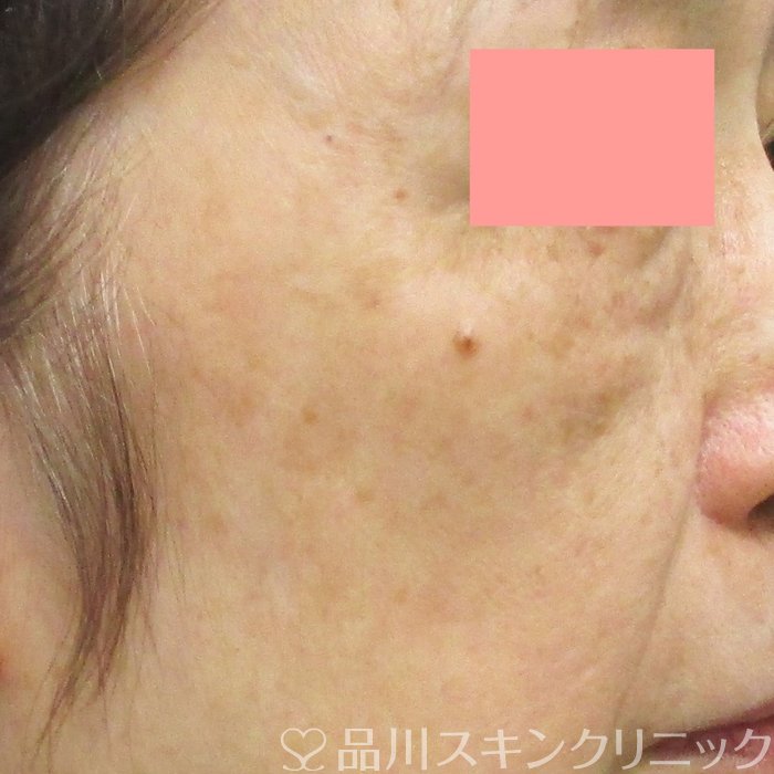 症例NO.71503のAFTER写真