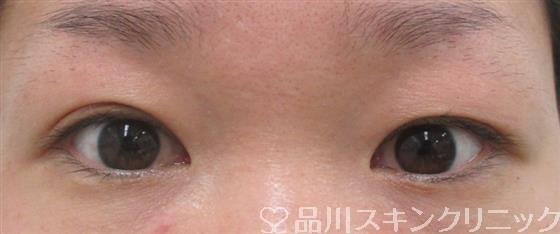 症例NO.27014のBEFORE写真