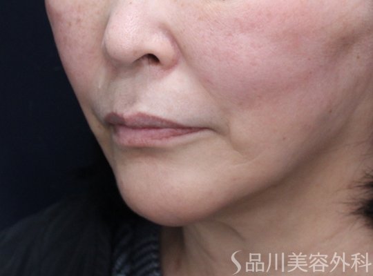 症例NO.72985のAFTER写真