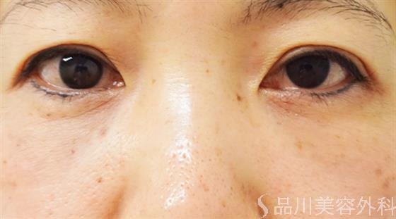 症例NO.31952のAFTER写真