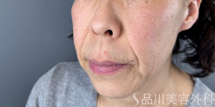 症例NO.72554のBEFORE写真