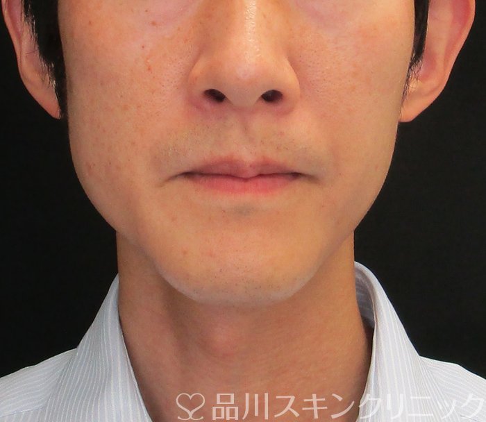 症例NO.73676のAFTER写真