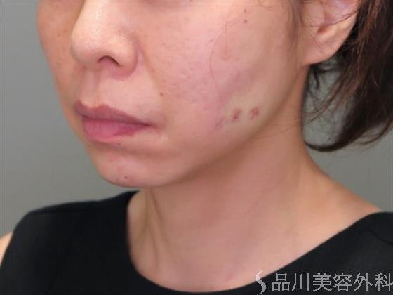 症例NO.48038のAFTER写真