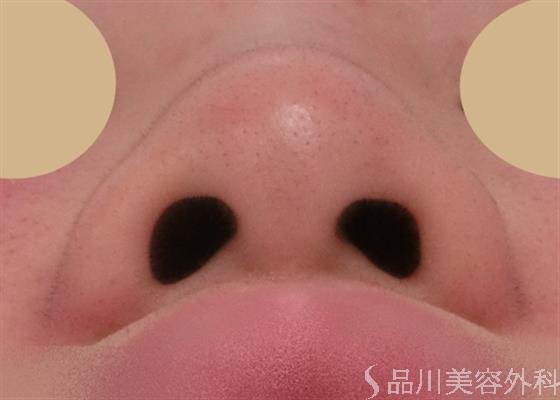 症例NO.27814のBEFORE写真