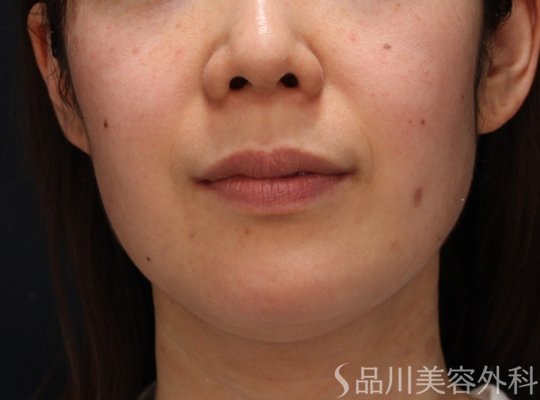 症例NO.74287のBEFORE写真
