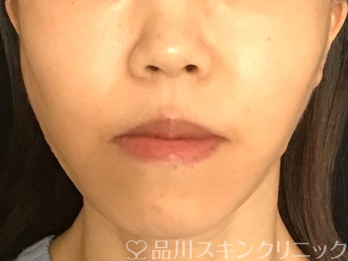 症例NO.65491のAFTER写真