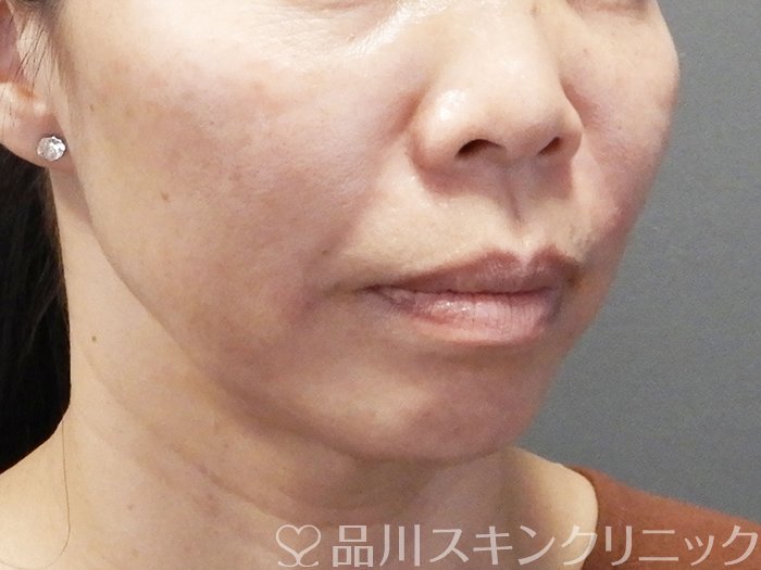 症例NO.73479のAFTER写真