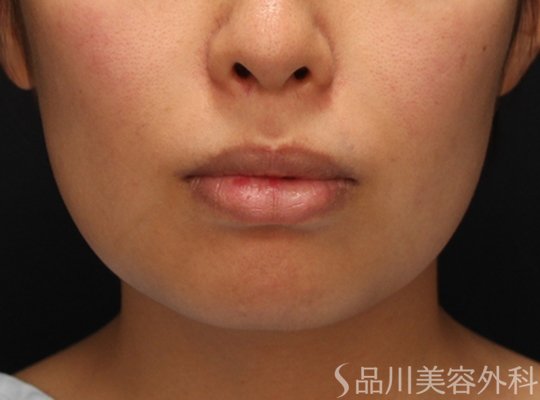 症例NO.73863のBEFORE写真