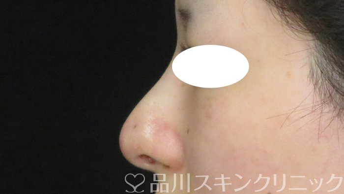 症例NO.74023のAFTER写真
