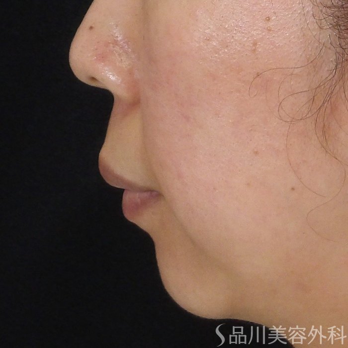 症例NO.70019のBEFORE写真