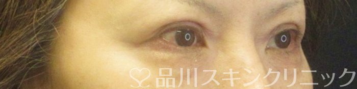 症例NO.66688のAFTER写真