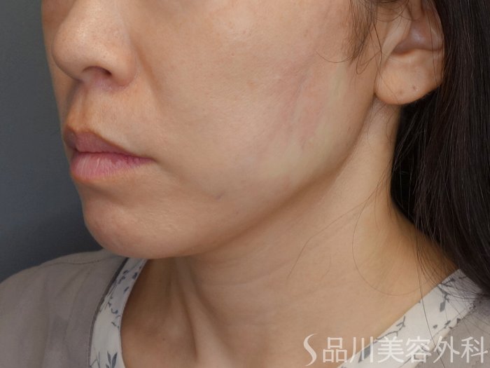 症例NO.72019のAFTER写真