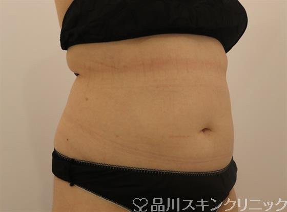 症例NO.42591のAFTER写真