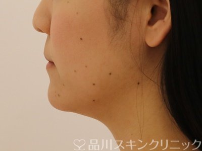 症例NO.71946のBEFORE写真