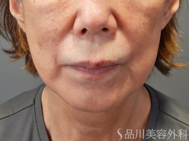 症例NO.73193のAFTER写真