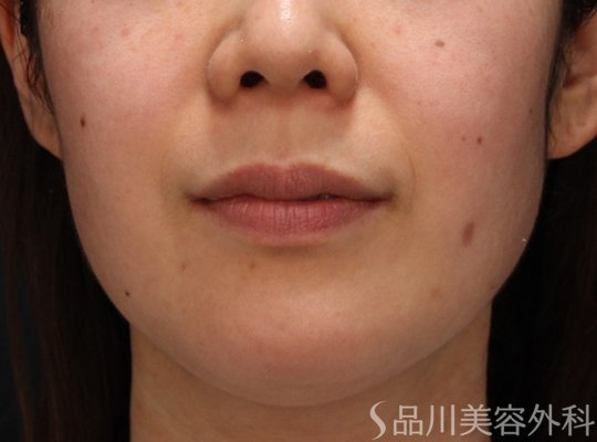 症例NO.73864のBEFORE写真