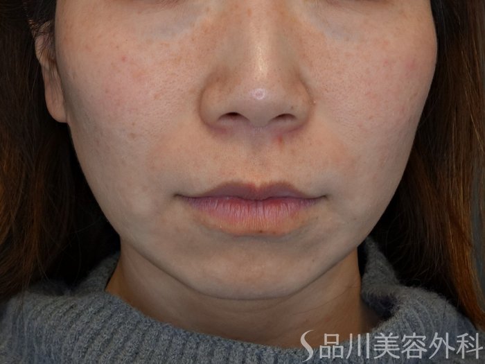 症例NO.74068のBEFORE写真