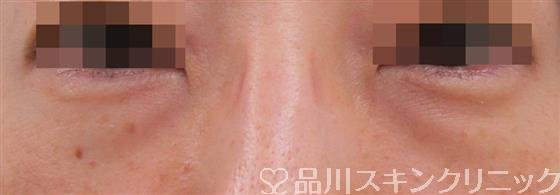 症例NO.37862のBEFORE写真