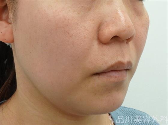 症例NO.46681のBEFORE写真