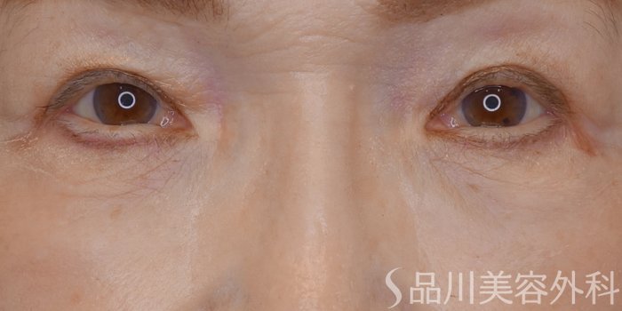 症例NO.72206のAFTER写真