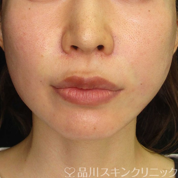 症例NO.62279のAFTER写真