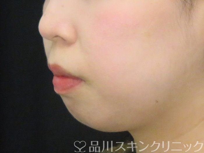 症例NO.67593のBEFORE写真