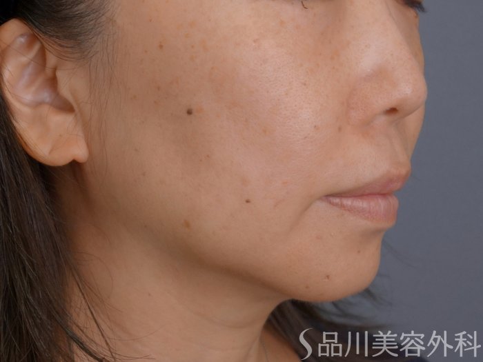 症例NO.74954のBEFORE写真